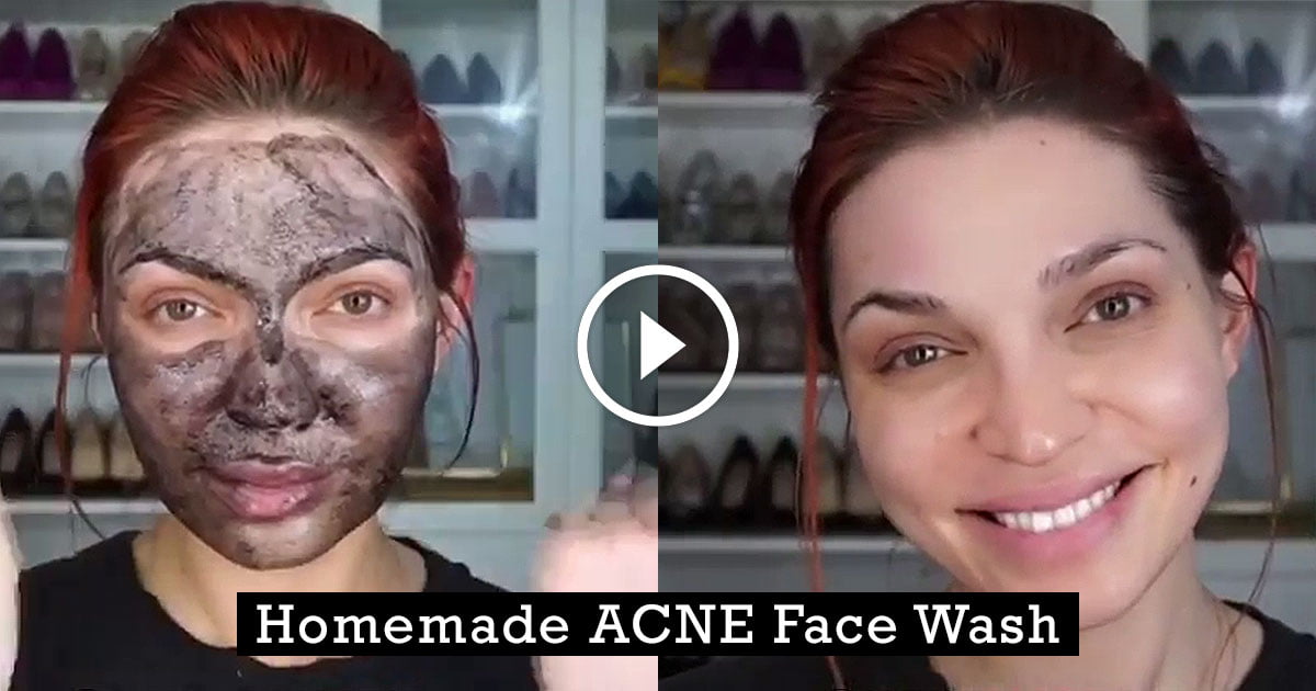 Homemade Acne Face Wash For Pimple Free Clear Skin