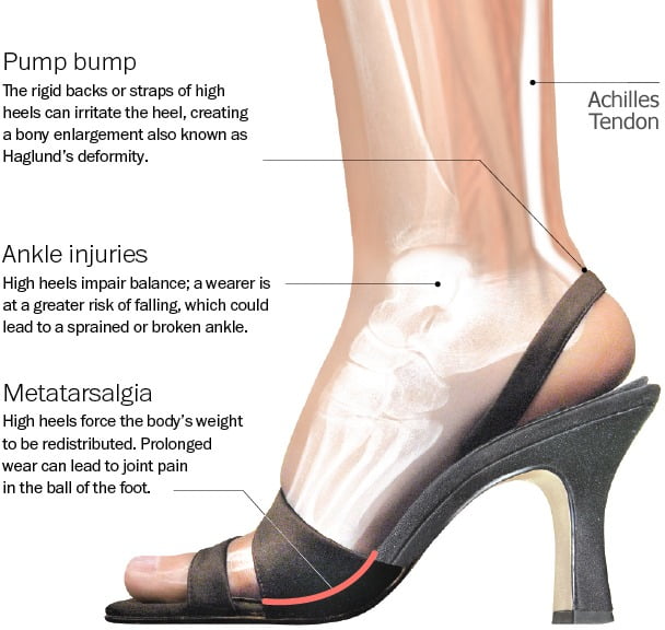 High heel shoed can cause nerve and bone damage in women's feet