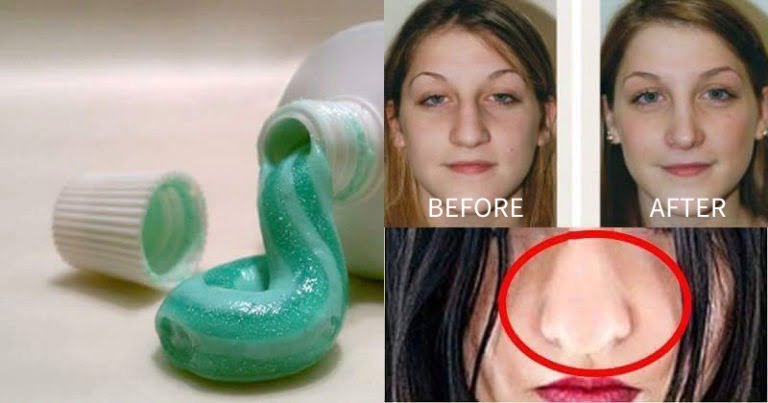 Home Remedy To Make Fat Nose Thinner Naturally Without Surgery