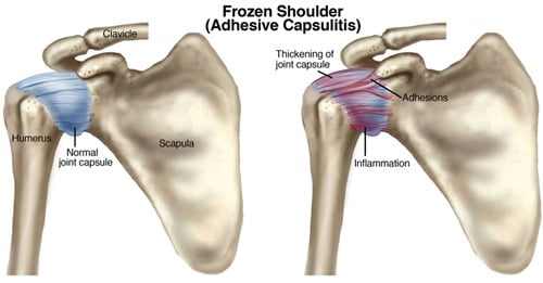 Frozen Shoulder Inflamed Capsule
