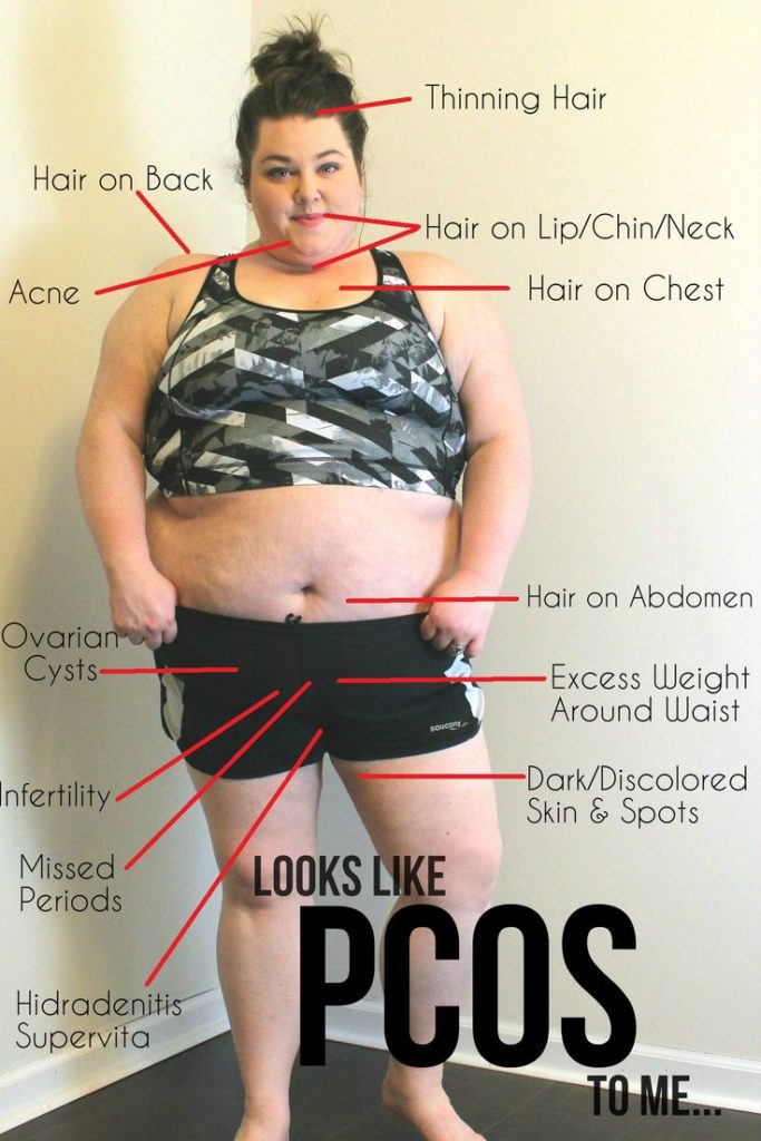 PCOS Symptoms