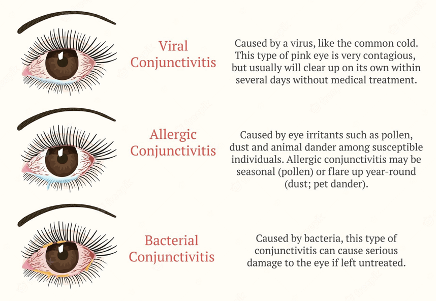 Conjunctivitis Pink Eye Causes