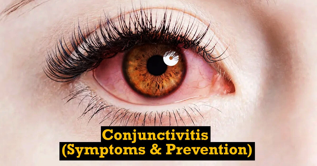 Conjunctivitis Symptoms and Prevention